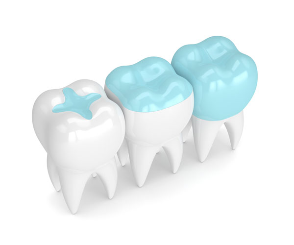 dental-sealants-belleview-dental-01 Dental sealants