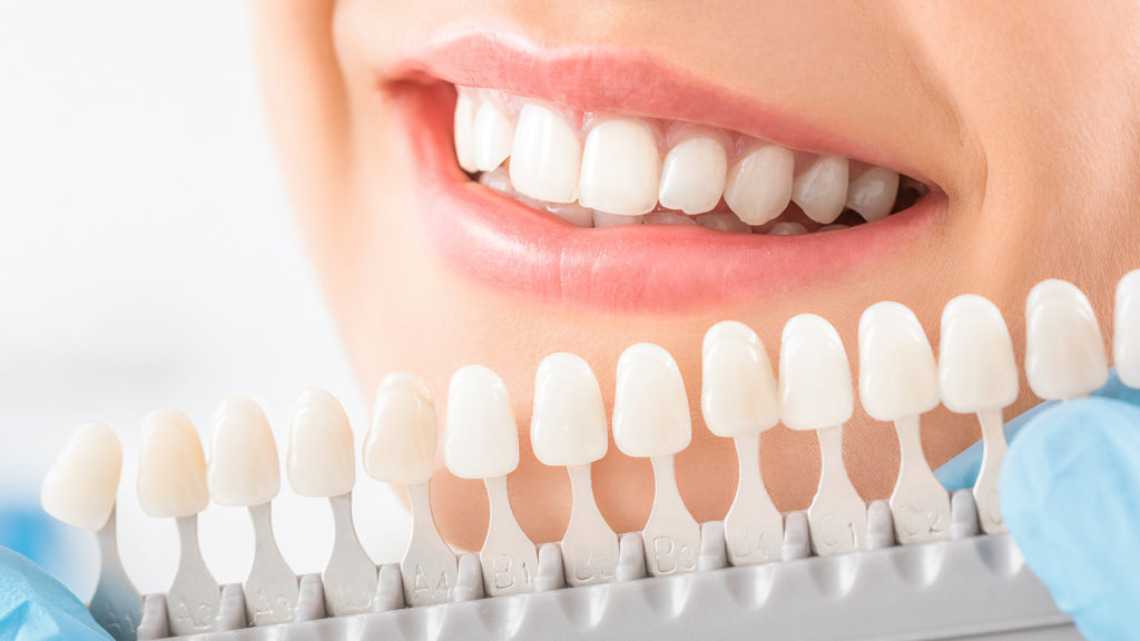 Littleton Denver Dentist Teeth Whitening